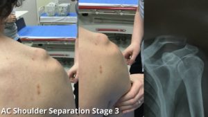 AC joint separation stage 3