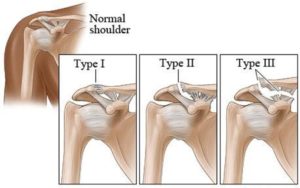 AC Joint Separation